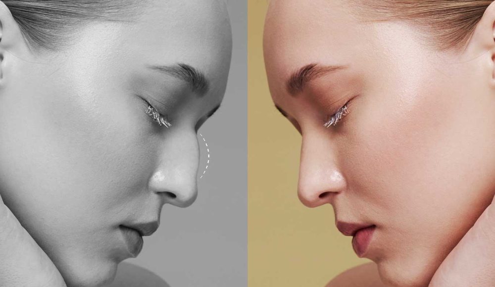 Rhinoplasty Surgery – Are You the Right Candidate for Rhinoplasty?