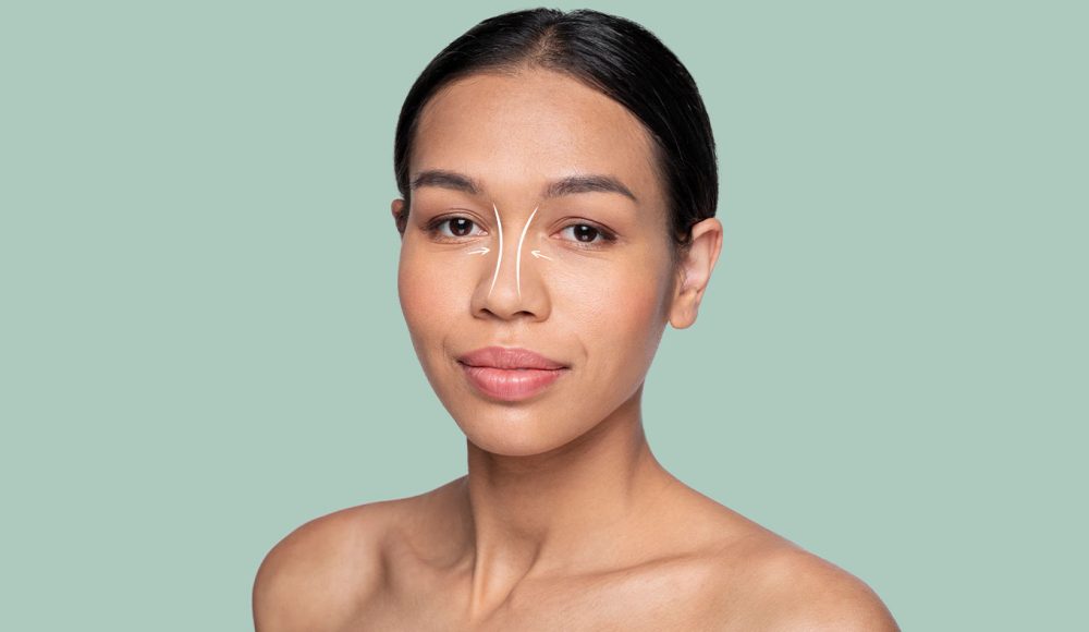 Aquiline Nose Rhinoplasty – Enhancing Nasal Dorsum Aesthetics