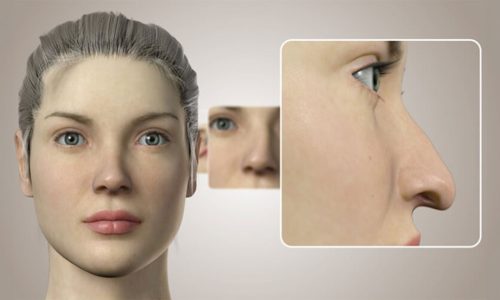 3D Burun Simülasyonu ile Rinoplasti Planlaması Nasıl Yapılır?
