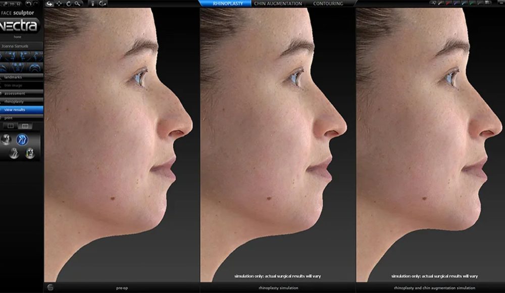 Chirurgie 3D Vectra en Turquie : Obtenez le nez de vos rêves grâce à la planification chirurgicale 3D