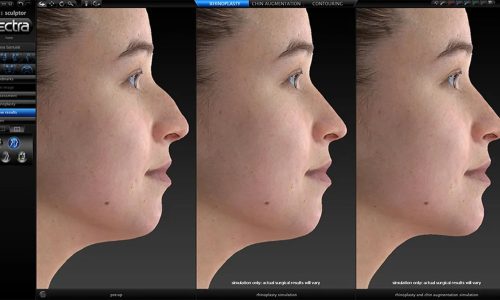 Chirurgie 3D Vectra en Turquie : Obtenez le nez de vos rêves grâce à la planification chirurgicale 3D