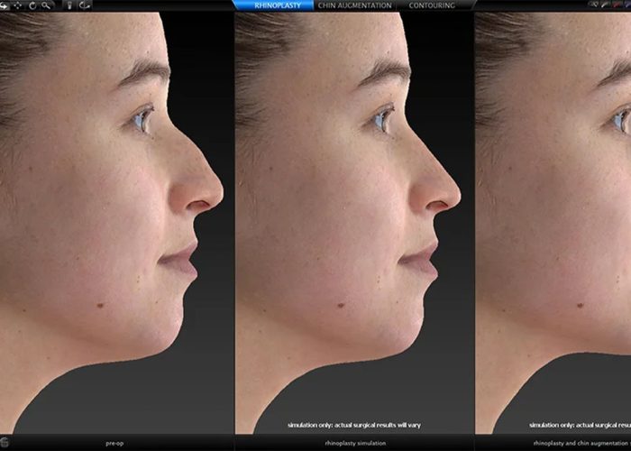3D Vectra in Turkey: Achieving Your Ideal Nose with 3D Surgical Planning
