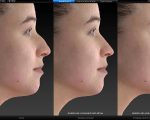 Burun Estetiğinde 3D Simülasyon: Sonucunuzu Önceden Görün!